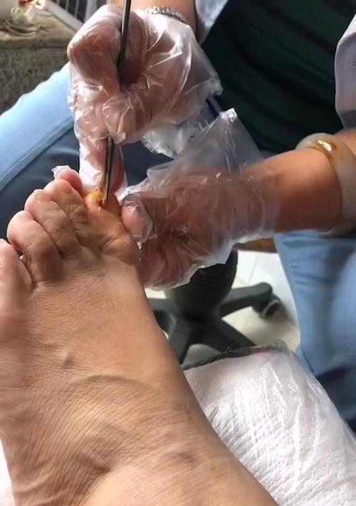 狗狗趾甲发炎的原因及预防措施（探究狗狗甲沟炎的主要诱因和免疫系统问题）